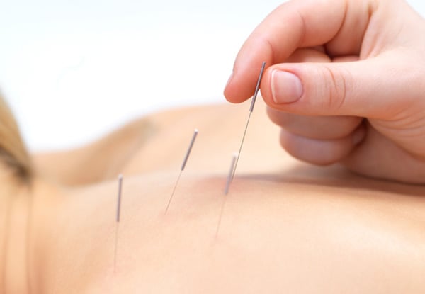 From $49 for a 75-Minute Initial Consultation & Acupuncture Treatment (value up to $190)
