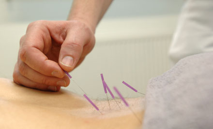Acupuncture