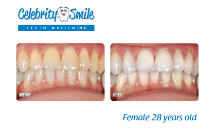 Celebrity Smile Teeth Whitening