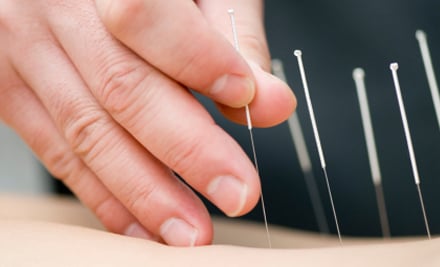 Acupuncture With Debbie