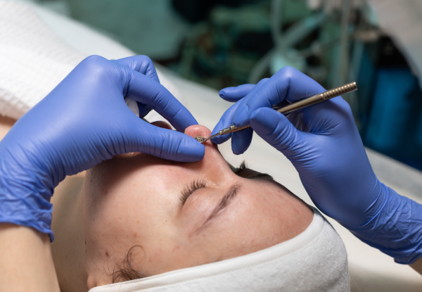 60-Minute Clinical Acne Extraction for One Person