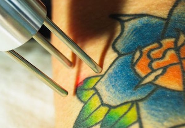 $570 for Six Tattoo Removal Sessions of a 5 x 10cm Tattoo (value up to $1,140)