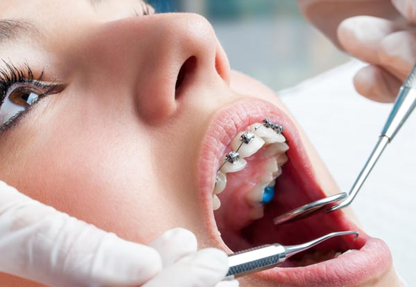 $2,000 Voucher Towards Fast Braces /  Orthodontic Assessment