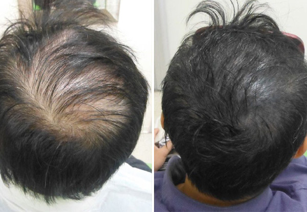 Scalp Micropigmentation Density Package - Options for Small, Medium, Large Patch or Full-Head