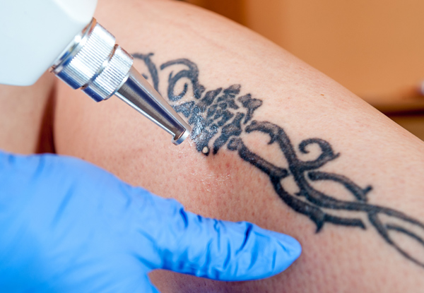 From $60 for Two Tattoo Removal Sessions (value up to $350)