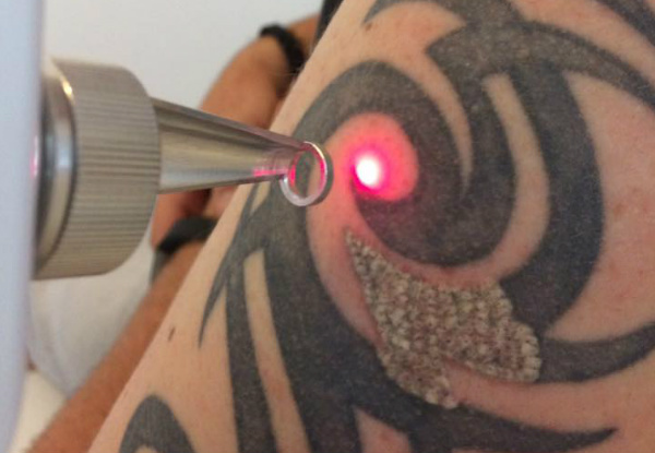 Three Wishes Tattoo Removal