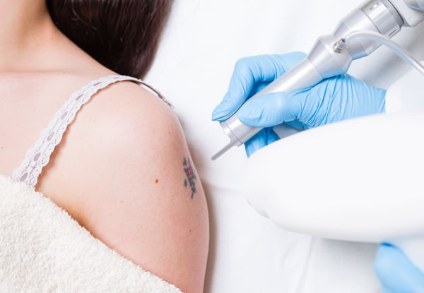 $59 for a Tattoo Removal or Fade Treatment for an Area up to ½ an A4 size or $79 for an Area up to ¾ of an A4 page (value up to $200)