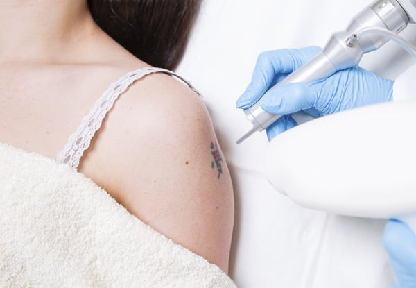 $100 for Four Tattoo Removal Sessions for Areas up to 132mm² (value up to $700)