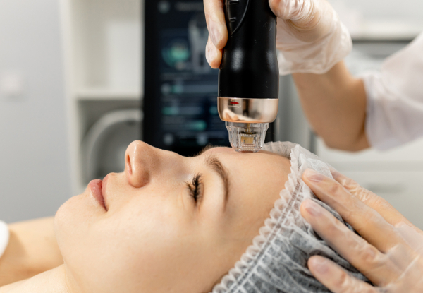 Secret RF Treatment (Radio Frequency Microneedling) For One