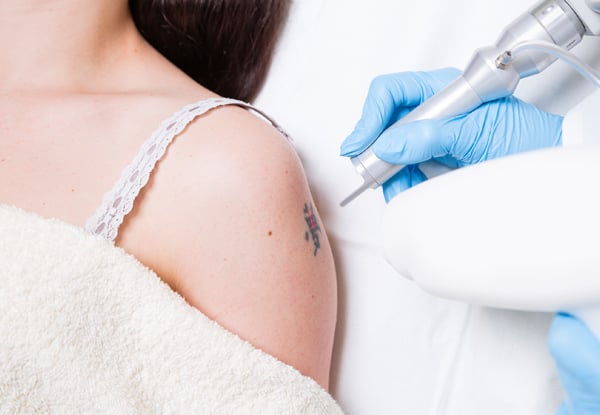 $139 for Three Laser Tattoo Removal or Fade Sessions for an Area up to ½ A4 size (value up to $1,050)