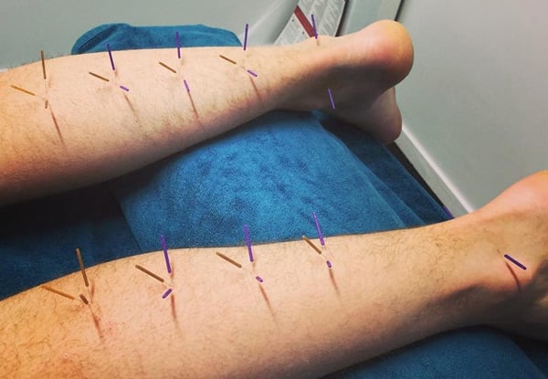 Acute Acupuncture