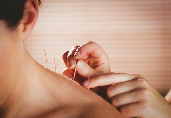 45-Minute Acupuncture Session - Options for Six Sessions, 45-Minute Cosmetic Acupuncture, or 30-Minute Cupping Session