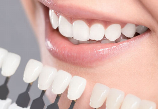 90-Minute Ultimate Teeth Whitening Session at Lovelysmiles Auckland