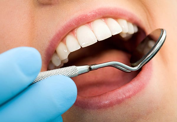 $170 for One White Composite Filling, $290 for Two Fillings or $390 for Three Fillings