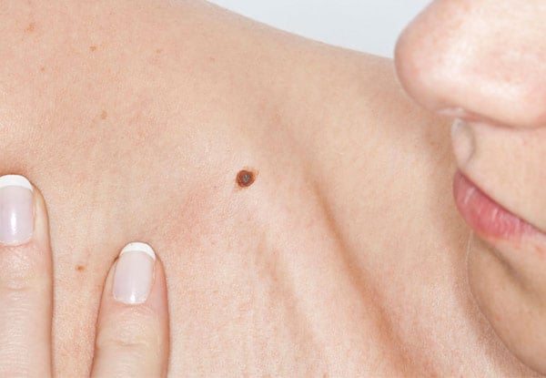 $112 for a Full Body NAEVUS Mole Mapping Consultation Incl. Skin Cancer & Melanoma Check with Digital Dermoscopy (value up to $225)