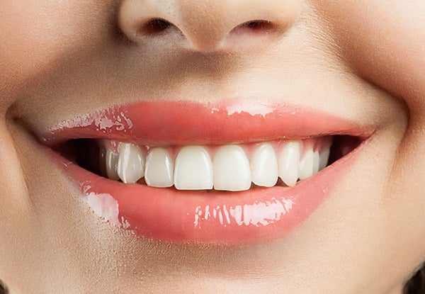 60-Minute Sensitivity & Pain-Free Whitening Package (NZ FernMark Accredited) - Option for 75-Minutes or 90-Minutes incl. Black Label Enhancement Kit