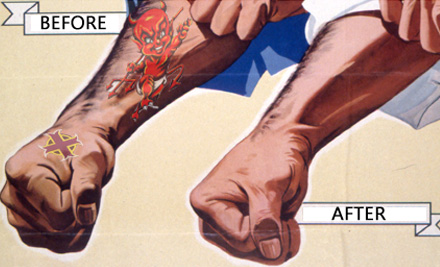 INK EDIT Tattoo Laser Removal