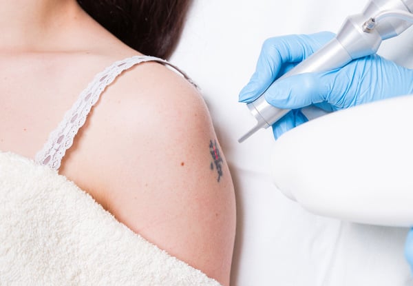 Three Tattoo-Removal Sessions - Options for up to Twelve Square Inches