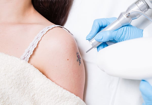 From $59 for Two Tattoo Removal Sessions – Three Sizes Available