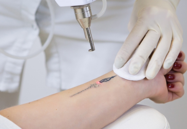 Delete Laser Tattoo Removal up to 3cm x 3cm