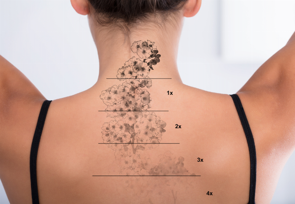 One Tattoo Lightening Treatment Session for One Person - Options for Different Sizes