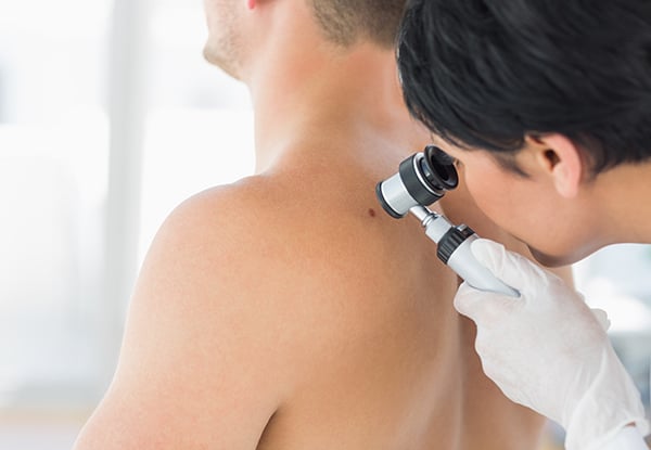 Full Mole Check & Consultation for One Person at St Lukes Medical Centre