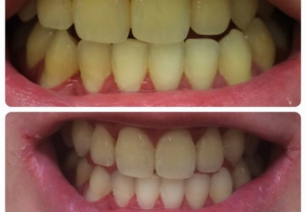 90-Minute Ultimate Teeth Whitening Session at Lovelysmiles Wellington CBD — photo 4