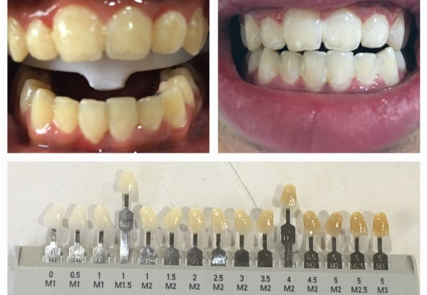 90-Minute Ultimate Teeth Whitening Session at Lovelysmiles Wellington CBD — photo 5