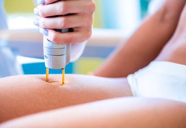 Three Laser Hair Removal Sessions for One Person - Range of Areas Available — photo 3